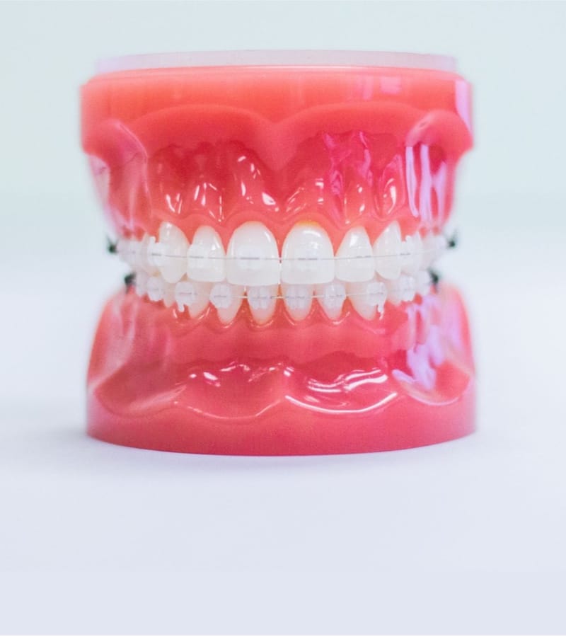 ceramic braces on plastic model