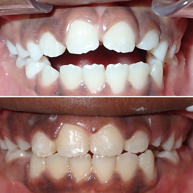 Shine Orthodontics before & afters