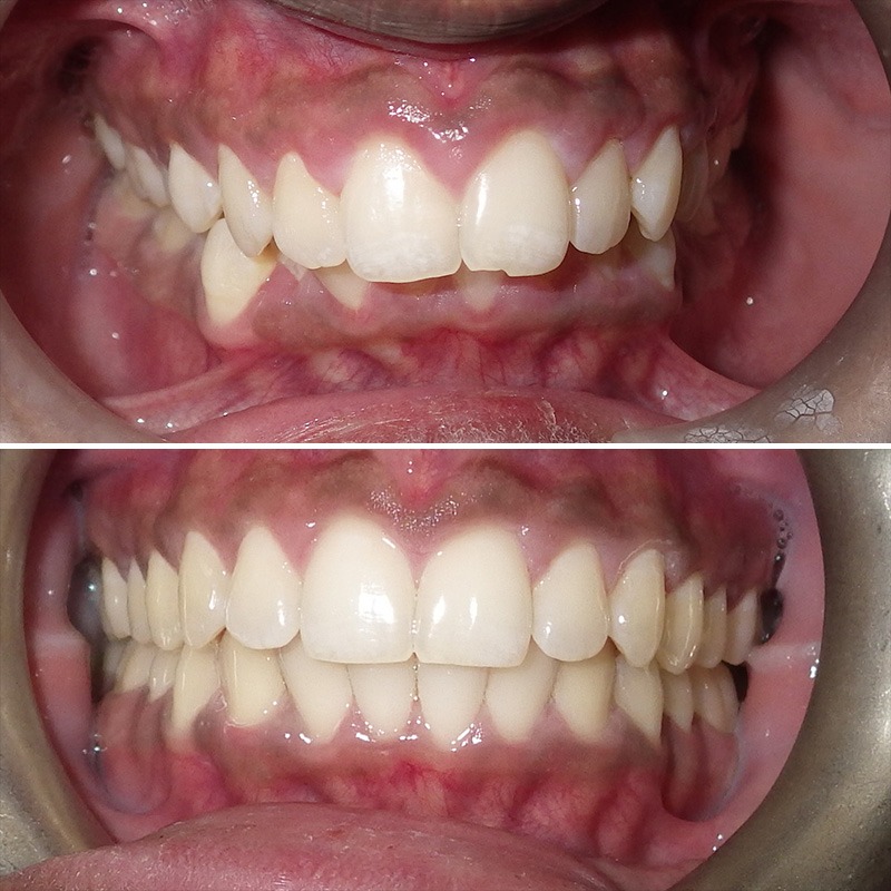 Shine Orthodontics before & afters