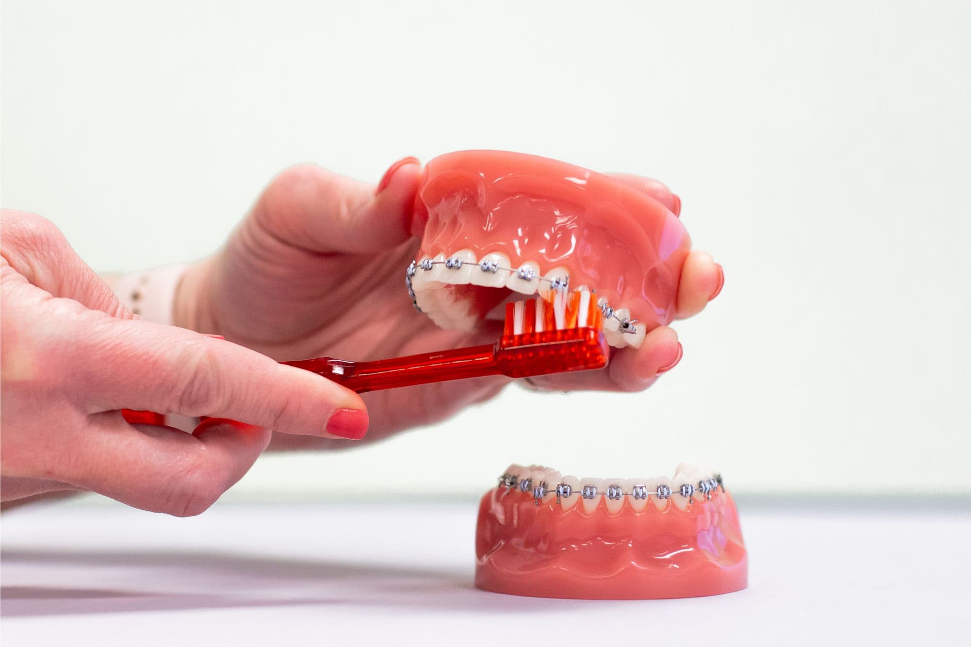 Hands holding a dental model with metal braces, brushing with a red toothbrush, emphasizing orthodontic care and hygiene in the context of braces treatment at Shine Orthodontics.