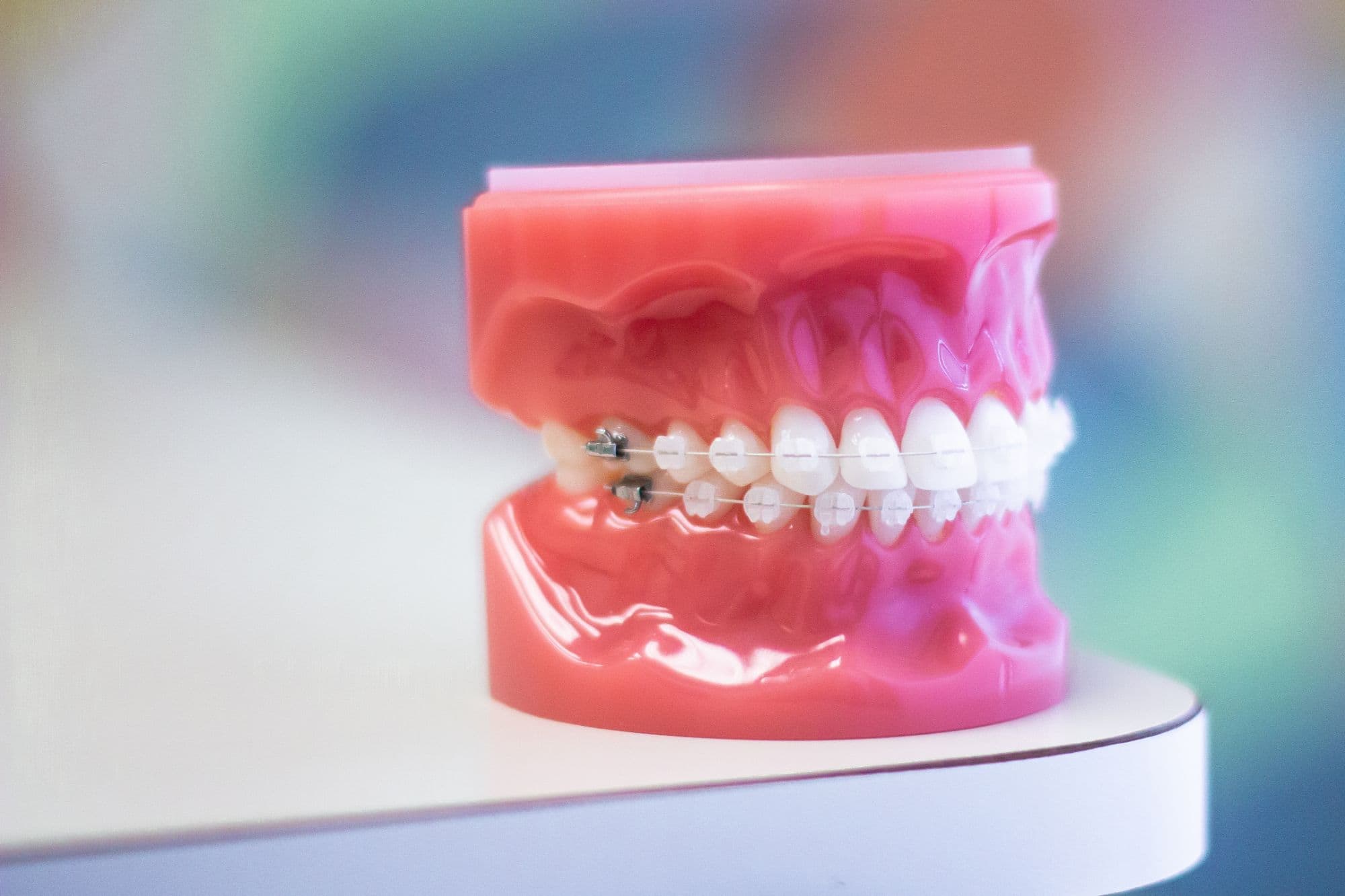 Model of a mouth with traditional metal braces, showcasing orthodontic treatment options relevant to Shine Orthodontics and Apex braces.
